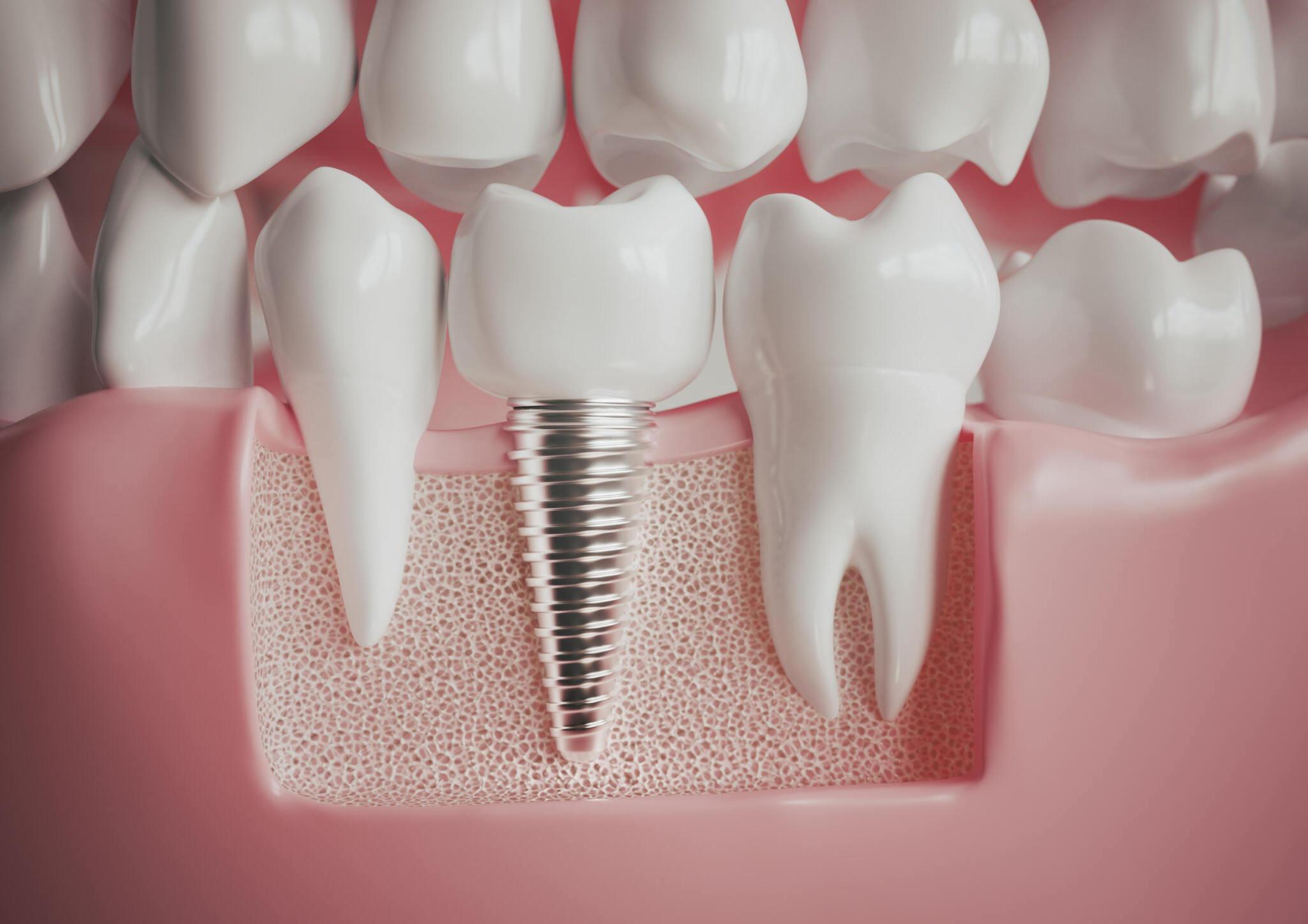 Rediscover Your Smile with Dental Implants in Charleston